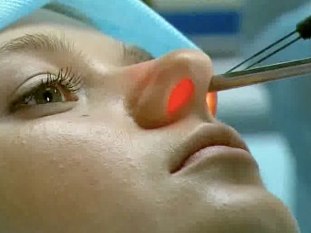 PolipN Пластика носа, лазерная операция на нос и ее достоинства