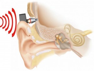 1_600-300x228 Энергонезависимые импланты для улучшения слуха