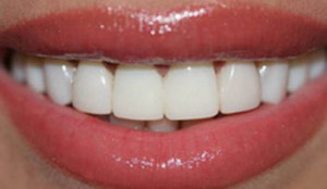 15824a627377a1e67f222655aff8bf70-300x174 Современные эстетические методы восстановления зубов