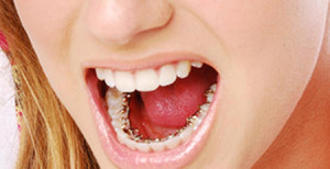 613-300x154 Лечение зубов при помощи брекетов