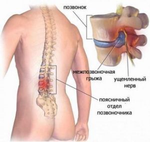 priznaki-mezhpozvonochnoj-gryzhi_1-300x285 Мои симптомы из-за межпозвоночной грыжи. Личное.