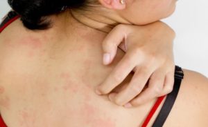 woman-rash-allergy-121005-774x320-300x184 Клиническое течение, принципы лечения и профилактики опоясывающего лишая у взрослых