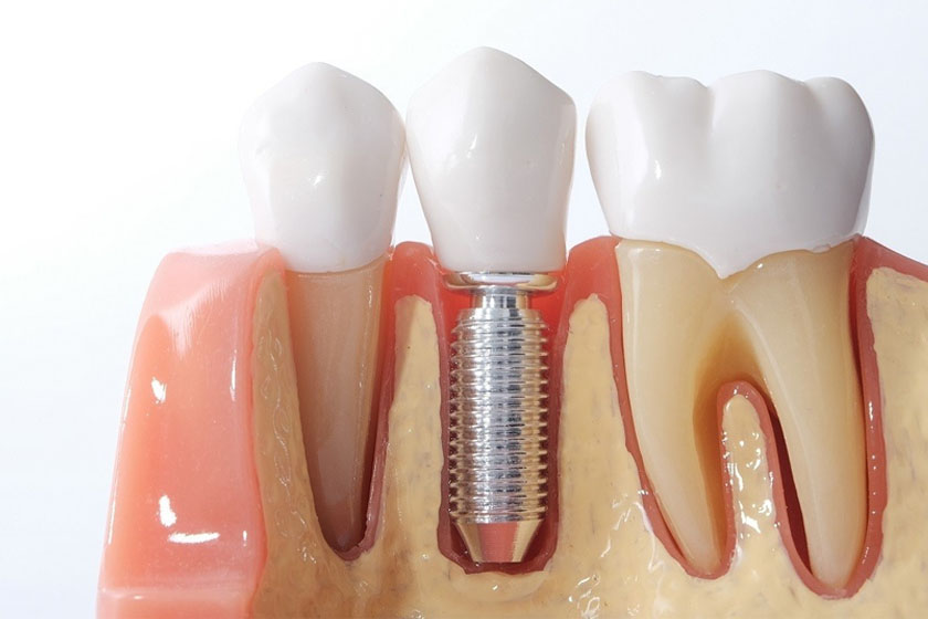 2-1 Все об имплантации зубов: кому подойдет, плюсы и особенности