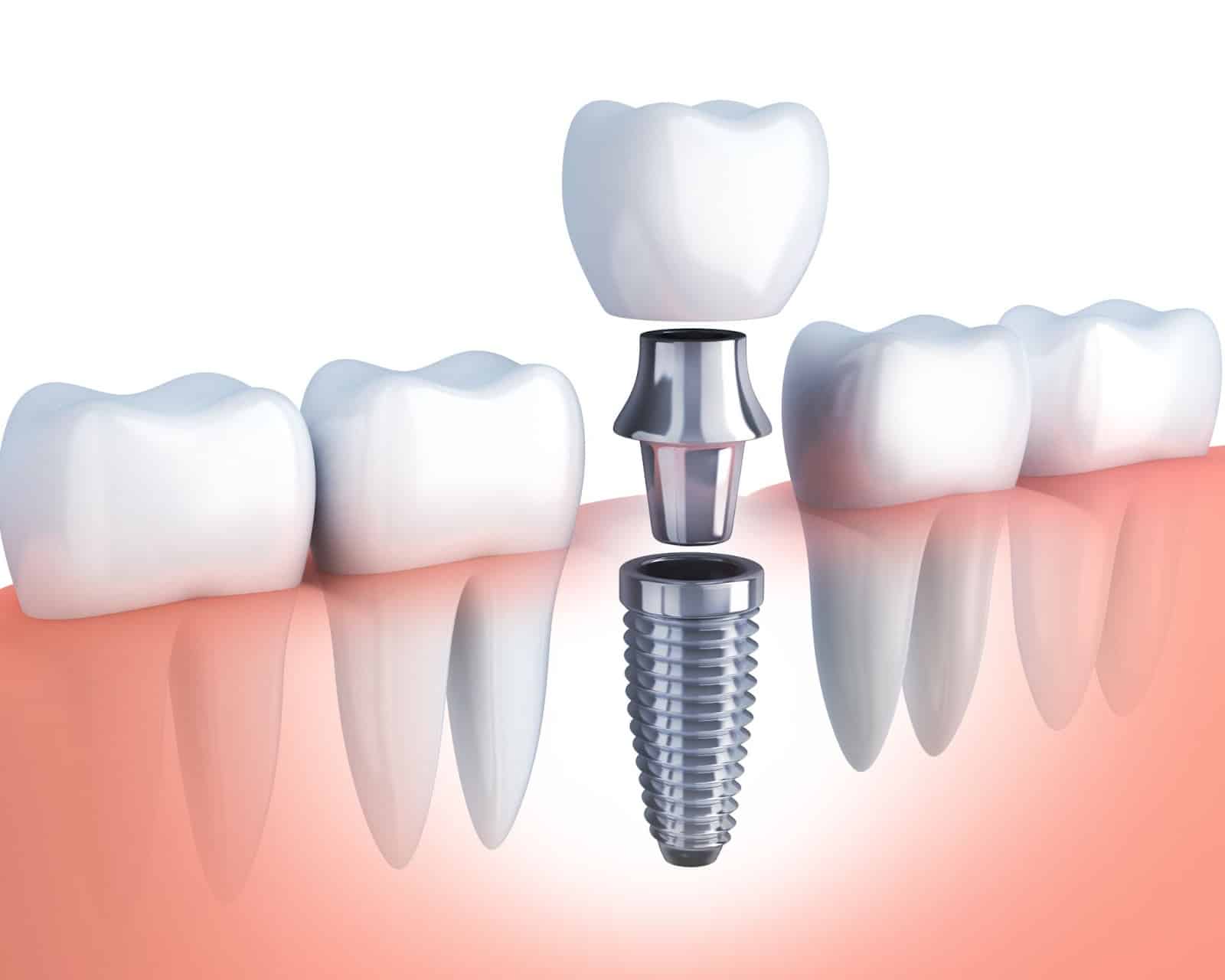 Dental-Implants-A-Solution-to-Your-Missing-Teeth Имплантация зубов: современные технологии и преимущества